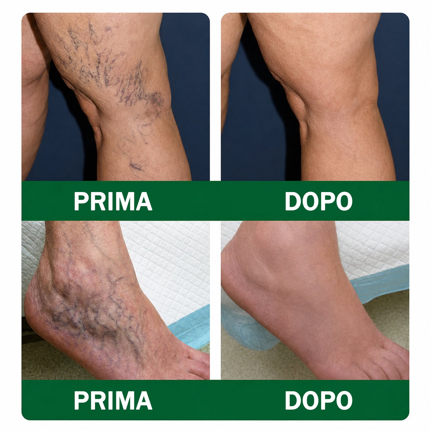 👨‍⚕️✅❤️DR.Fachmer® Cerotto ai Microaghi VeinRepair⚡Sollievo Immediato, Risultati a Lungo Termine