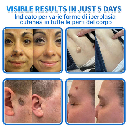 ✅ DR.Fachmen® Cerotto 2-in-1 con Microaghi e Idrocolloide | Per Brufoli, Verruche Piane ed Escrescenze Cutanee | Aiuta a Ridurre Rughe, Cicatrici e Imperfezioni | Invisibile su Viso e Corpo