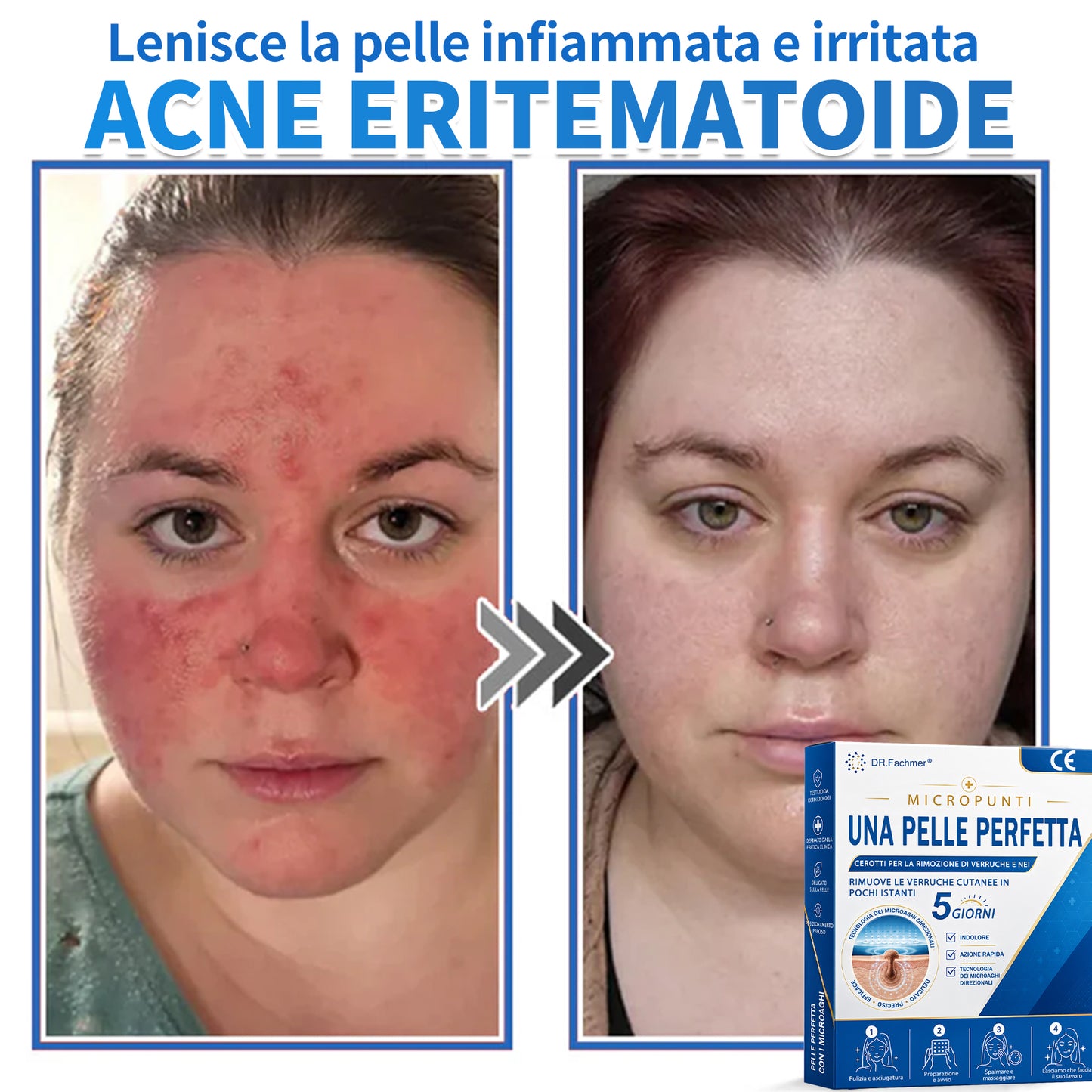 ✅ DR.Fachmen® Cerotto 2-in-1 con Microaghi e Idrocolloide | Per Brufoli, Verruche Piane ed Escrescenze Cutanee | Aiuta a Ridurre Rughe, Cicatrici e Imperfezioni | Invisibile su Viso e Corpo