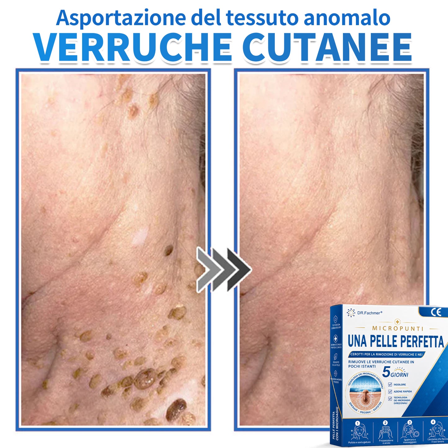 ✅ DR.Fachmen® Cerotto 2-in-1 con Microaghi e Idrocolloide | Per Brufoli, Verruche Piane ed Escrescenze Cutanee | Aiuta a Ridurre Rughe, Cicatrici e Imperfezioni | Invisibile su Viso e Corpo